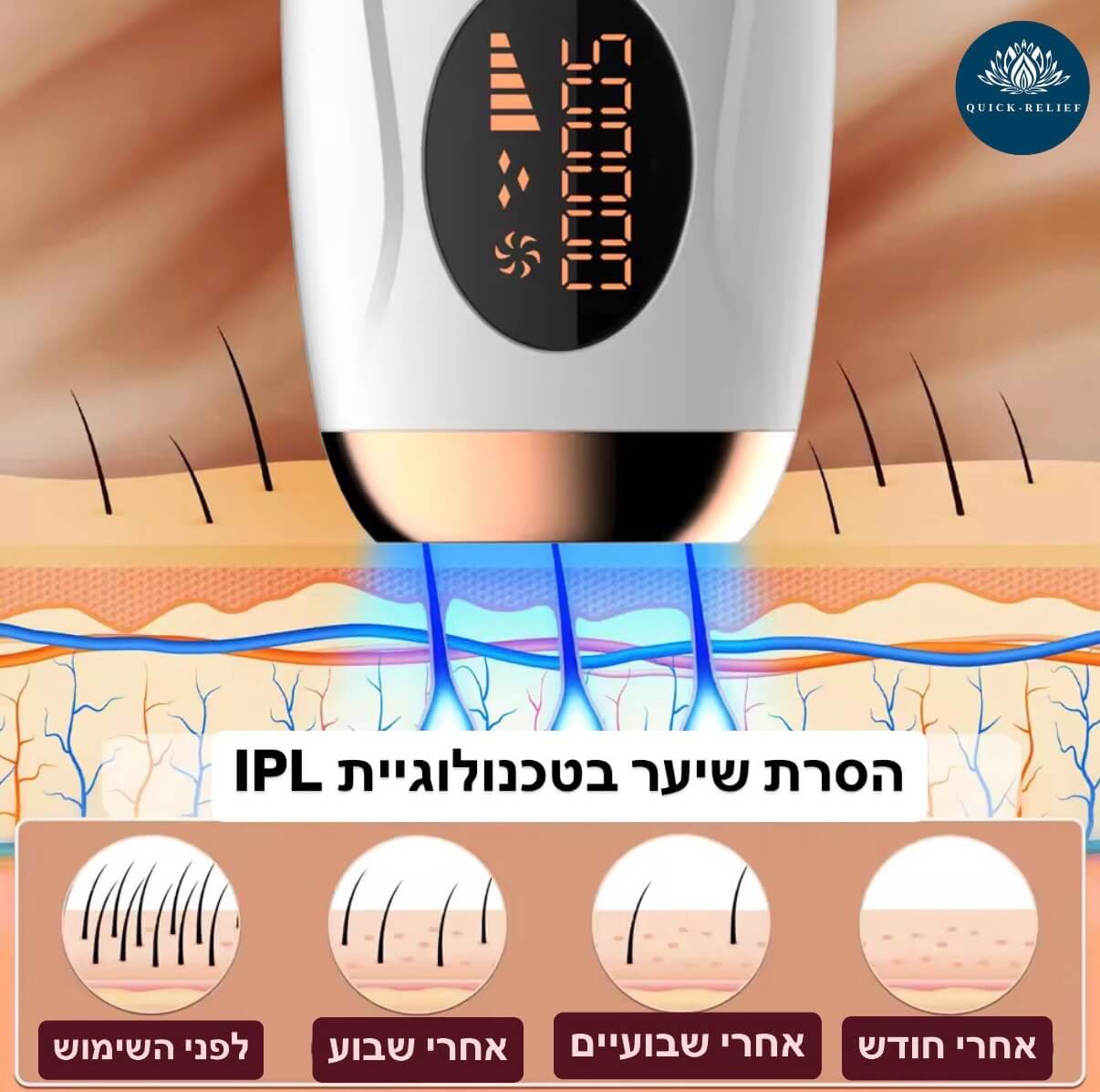 הסרת שיער בטכנולוגיית IPL