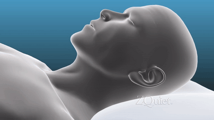 נשכן לנחירות ודום נשימה