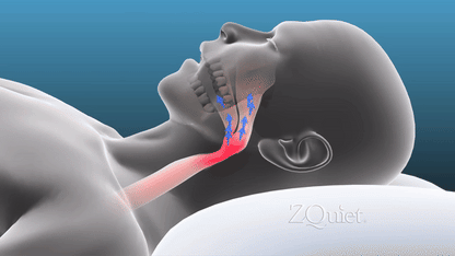 נשכן לנחירות ודום נשימה