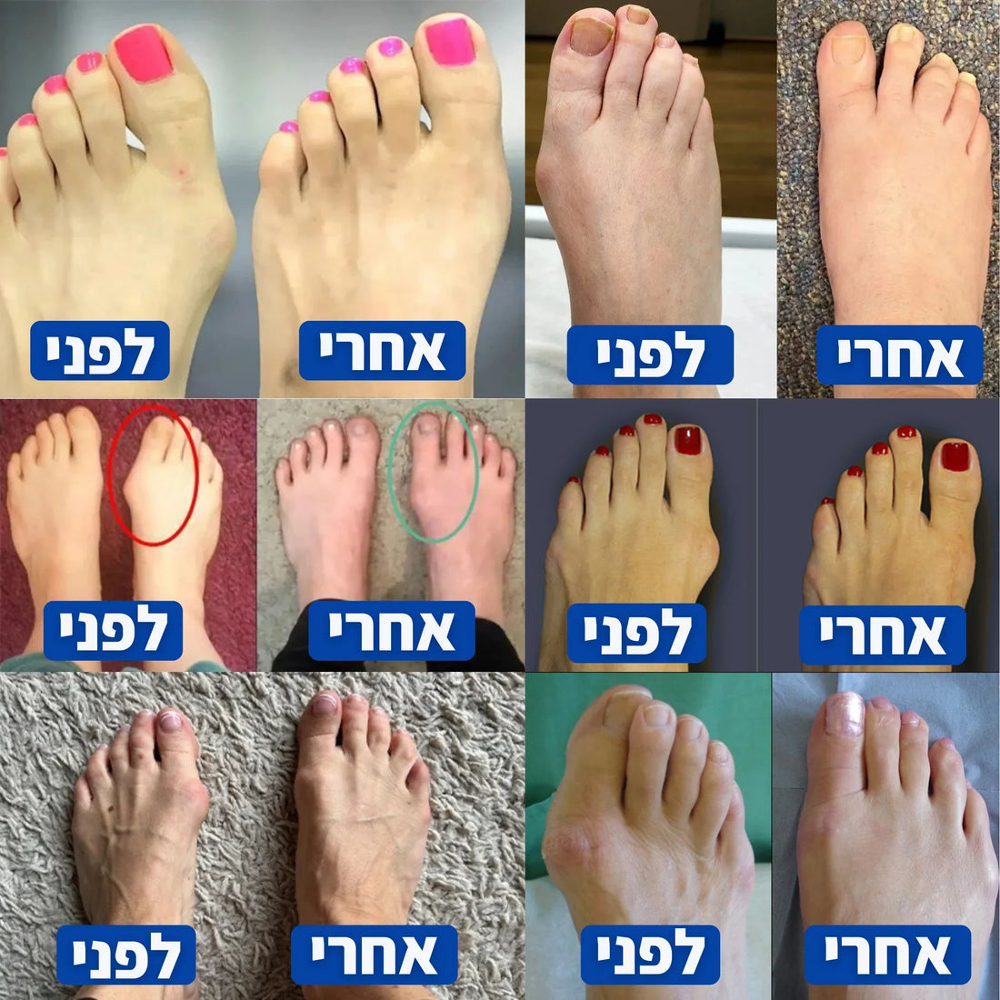 מפריד בוהן